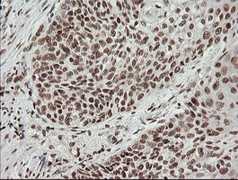 MCTS1 Antibody - IHC of paraffin-embedded Carcinoma of Human bladder tissue using anti-MCTS1 mouse monoclonal antibody. (Heat-induced epitope retrieval by 10mM citric buffer, pH6.0, 100C for 10min).