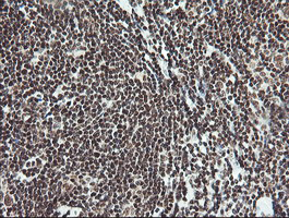 MCTS1 Antibody - IHC of paraffin-embedded Human lymphoma tissue using anti-MCTS1 mouse monoclonal antibody. (Heat-induced epitope retrieval by 10mM citric buffer, pH6.0, 100C for 10min).