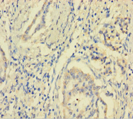 MCTS1 Antibody - Immunohistochemistry of paraffin-embedded human pancreatic cancer using MCTS1 Antibody at dilution of 1:100