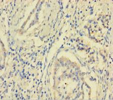 MCTS1 Antibody - Immunohistochemistry of paraffin-embedded human pancreatic cancer using MCTS1 Antibody at dilution of 1:100