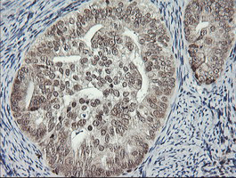 MCTS1 Antibody - IHC of paraffin-embedded Adenocarcinoma of Human endometrium tissue using anti-MCTS1 mouse monoclonal antibody.