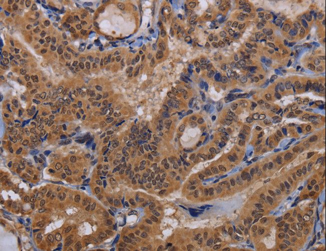 MCTS1 Antibody - Immunohistochemistry of paraffin-embedded Human thyroid cancer using MCTS1 Polyclonal Antibody at dilution of 1:60.