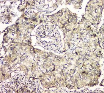 MCUR1 / CCDC90A Antibody - IHC staining of FFPE human lung cancer tissue with MCUR1 antibody at 1ug/ml. HIER: boil tissue sections in pH6, 10mM citrate buffer, for 10-20 min and allow to cool before testing.