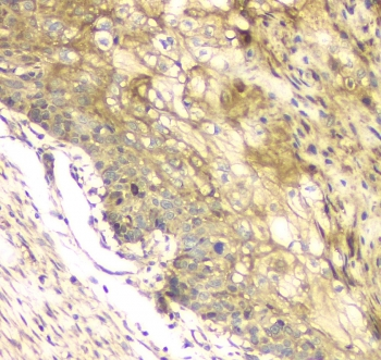MCUR1 / CCDC90A Antibody - IHC staining of FFPE human esophageal squamous cancer with MCUR1 antibody at 1ug/ml. HIER: boil tissue sections in pH6, 10mM citrate buffer, for 10-20 min and allow to cool before testing.