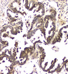 MCUR1 / CCDC90A Antibody - IHC staining of FFPE human ovarian cancer tissue with MCUR1 antibody at 1ug/ml. HIER: boil tissue sections in pH6, 10mM citrate buffer, for 10-20 min and allow to cool before testing.