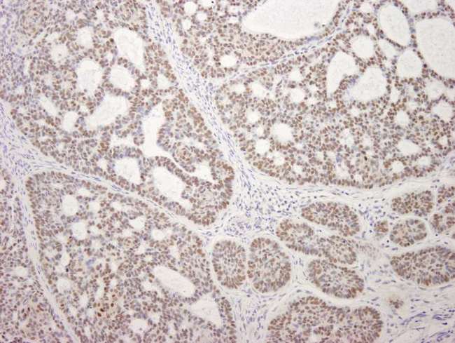 MDC1 Antibody - Detection of Human MDC1 by Immunohistochemistry. Sample: FFPE section of human skin tumor. Antibody: Affinity purified rabbit anti-MDC1 used at a dilution of 1:250. Detection: DAB staining using anti-Rabbit IHC antibody at a dilution of 1:100.