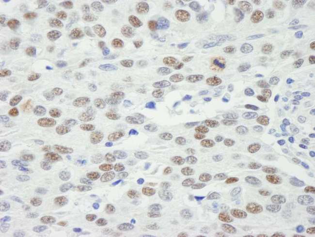 MDC1 Antibody - Detection of Human MDC1 by Immunohistochemistry. Sample: FFPE section of human breast adenocarcinoma. Antibody: Affinity purified rabbit anti-MDC1 used at a dilution of 1:250. Detection: DAB staining using anti-Rabbit IHC antibody at a dilution of 1:100.