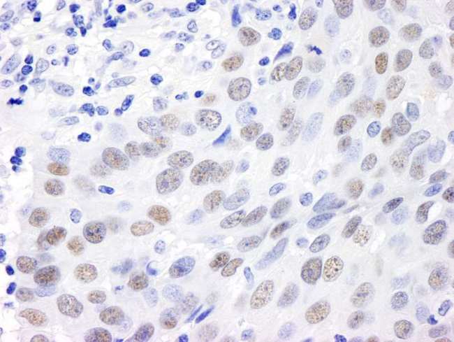 MDC1 Antibody - Detection of Human MDC1 by Immunohistochemistry. Sample: FFPE section of human breast carcinoma. Antibody: Affinity purified rabbit anti-MDC1 used at a dilution of 1:1000 (1 ug/ml). Detection: DAB.