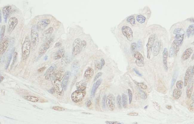 MDC1 Antibody - Detection of Human MDC1 by Immunohistochemistry. Sample: FFPE section of human ovarian carcinoma. Antibody: Affinity purified rabbit anti-MDC1 used at a dilution of 1:1000 (1 Detection: DAB.