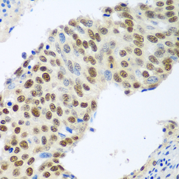 MDC1 Antibody - Immunohistochemistry of paraffin-embedded human lung cancer tissue.