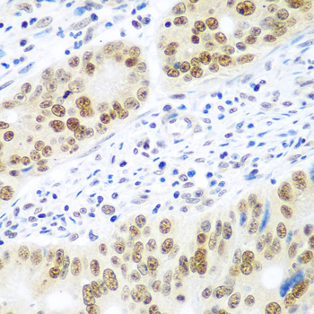 MDC1 Antibody - Immunohistochemistry of paraffin-embedded human colon carcinoma tissue.