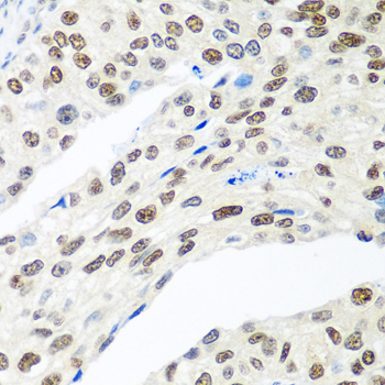 MDC1 Antibody - Immunohistochemistry of paraffin-embedded human prostate cancer tissue.