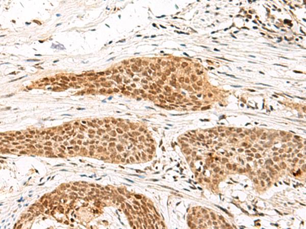 MDFI / I-MF Antibody - Immunohistochemistry of paraffin-embedded Human esophagus cancer tissue  using MDFI Polyclonal Antibody at dilution of 1:55(×200)