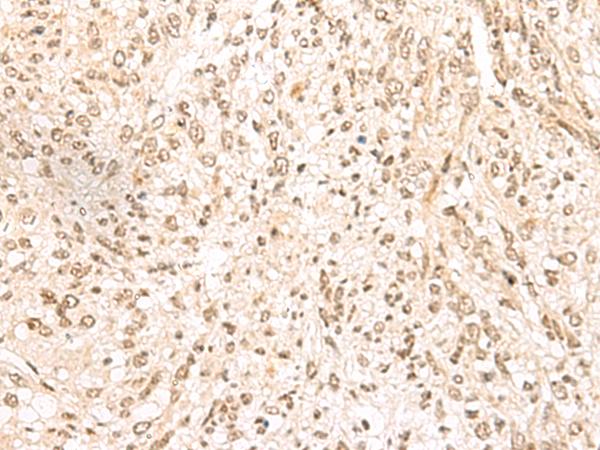 MDFI / I-MF Antibody - Immunohistochemistry of paraffin-embedded Human liver cancer tissue  using MDFI Polyclonal Antibody at dilution of 1:55(×200)