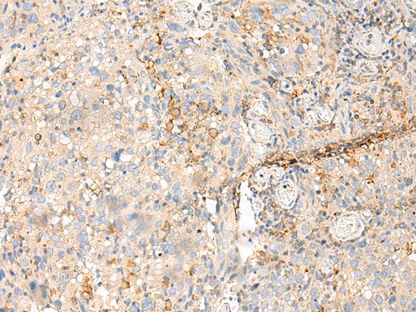 MDFI / I-MF Antibody - Immunohistochemistry of paraffin-embedded Human cervical cancer tissue  using MDFI Polyclonal Antibody at dilution of 1:50(×200)