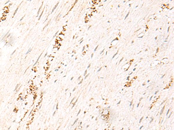 MDFI / I-MF Antibody - Immunohistochemistry of paraffin-embedded Human colorectal cancer tissue  using MDFI Polyclonal Antibody at dilution of 1:50(×200)