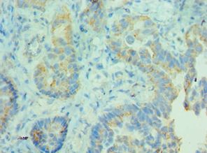 MDH / MDH2 Antibody - Immunohistochemistry of paraffin-embedded human lung cancer using antibody at 1:100 dilution.