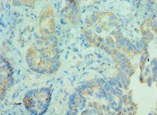 MDH / MDH2 Antibody - Immunohistochemistry of paraffin-embedded human lung cancer using antibody at 1:100 dilution.