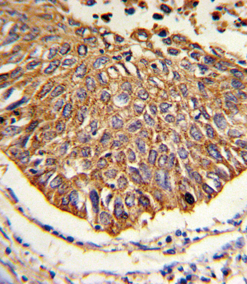 MDH / MDH2 Antibody - Formalin-fixed and paraffin-embedded human lung carcinoma reacted with MDH2 Antibody , which was peroxidase-conjugated to the secondary antibody, followed by DAB staining. This data demonstrates the use of this antibody for immunohistochemistry; clinical relevance has not been evaluated.