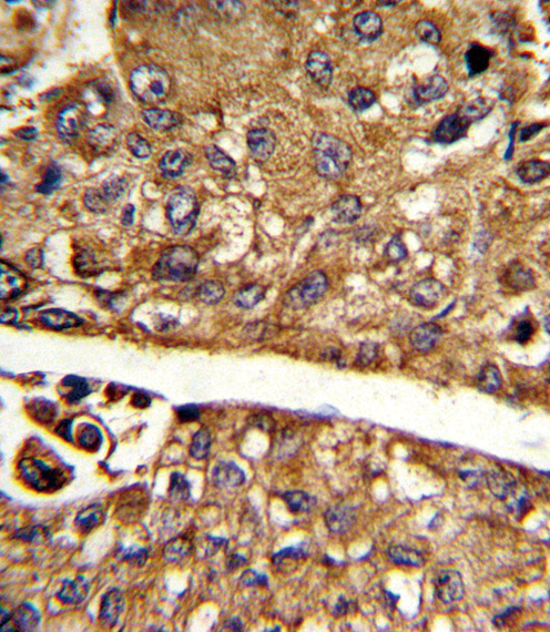 MDH1 Antibody - Formalin-fixed and paraffin-embedded human hepatocarcinoma reacted with MDH1 Antibody , which was peroxidase-conjugated to the secondary antibody, followed by DAB staining. This data demonstrates the use of this antibody for immunohistochemistry; clinical relevance has not been evaluated.