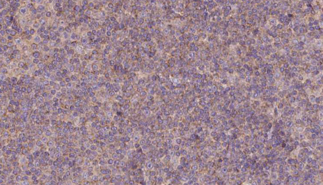 MDH1 Antibody - 1:100 staining human lymph carcinoma tissue by IHC-P. The sample was formaldehyde fixed and a heat mediated antigen retrieval step in citrate buffer was performed. The sample was then blocked and incubated with the antibody for 1.5 hours at 22°C. An HRP conjugated goat anti-rabbit antibody was used as the secondary.