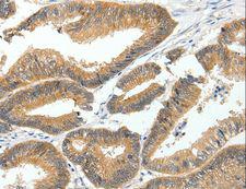 MDK / Midkine Antibody - Immunohistochemistry of paraffin-embedded Human lung cancer using MDK Polyclonal Antibody at dilution of 1:60.