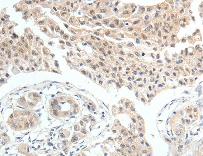 MDK / Midkine Antibody - Immunohistochemistry of paraffin-embedded Human lung cancer using MDK Polyclonal Antibody at dilution of 1:60.