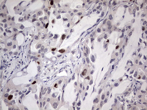 MDM2 Antibody - Immunohistochemical staining of paraffin-embedded Carcinoma of Human lung tissue using anti-MDM2 mouse monoclonal antibody. (Heat-induced epitope retrieval by 1 mM EDTA in 10mM Tris, pH8.5, 120C for 3min,