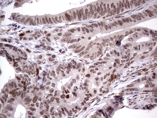 MDM2 Antibody - Immunohistochemical staining of paraffin-embedded Adenocarcinoma of Human colon tissue using anti-MDM2 mouse monoclonal antibody. (Heat-induced epitope retrieval by 1 mM EDTA in 10mM Tris, pH8.5, 120C for 3min,