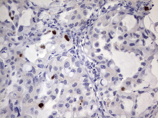 MDM2 Antibody - Immunohistochemical staining of paraffin-embedded Carcinoma of Human lung tissue using anti-MDM2 mouse monoclonal antibody. (Heat-induced epitope retrieval by 1 mM EDTA in 10mM Tris, pH8.5, 120C for 3min,