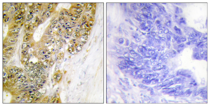 MDM2 Antibody - Immunohistochemistry analysis of paraffin-embedded human colon carcinoma tissue, using MDM2 Antibody. The picture on the right is blocked with the synthesized peptide.