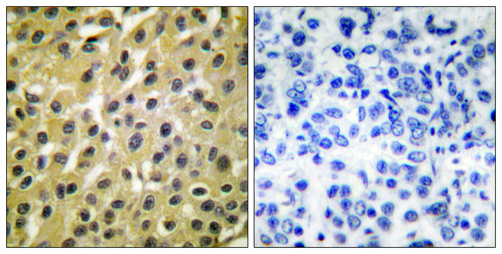 MDM2 Antibody - Immunohistochemistry analysis of paraffin-embedded human breast carcinoma tissue, using MDM2 Antibody. The picture on the right is blocked with the synthesized peptide.