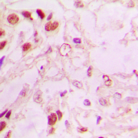 MDM2 Antibody - Immunohistochemical analysis of MDM2 staining in human lung cancer formalin fixed paraffin embedded tissue section. The section was pre-treated using heat mediated antigen retrieval with sodium citrate buffer (pH 6.0). The section was then incubated with the antibody at room temperature and detected using an HRP conjugated compact polymer system. DAB was used as the chromogen. The section was then counterstained with hematoxylin and mounted with DPX.