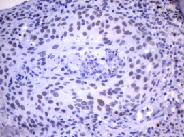 MDM2 Antibody - IHC of paraffin-embedded Carcinoma of Human lung tissue using anti-MDM2 mouse monoclonal antibody.