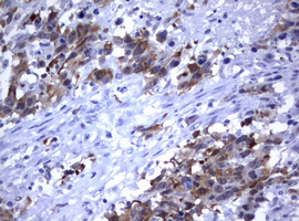 MDM2 Antibody - IHC of paraffin-embedded Adenocarcinoma of Human ovary tissue using anti-MDM2 mouse monoclonal antibody.