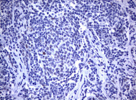 MDM2 Antibody - IHC of paraffin-embedded Human lymphoma tissue using anti-MDM2 mouse monoclonal antibody.