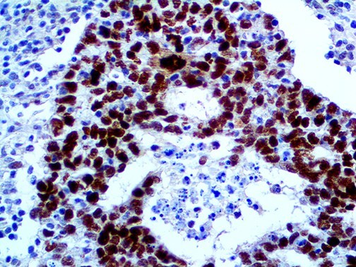 MDM2 Antibody - IHC of MDM2 on an FFPE Testicular Cancer Tissue