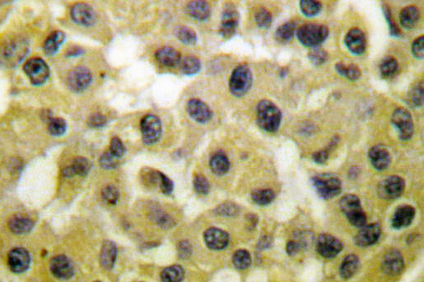 MDM2 Antibody - IHC of MDM2 (F414) pAb in paraffin-embedded human breast carcinoma tissue.