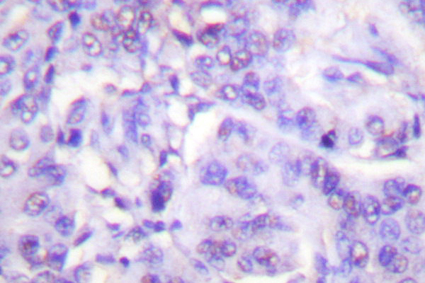MDM2 Antibody - IHC of p-MDM2 (S166) pAb in paraffin-embedded human breast carcinoma tissue.