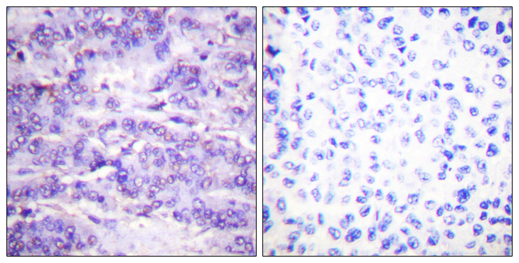 MDM2 Antibody - Immunohistochemistry analysis of paraffin-embedded human breast carcinoma, using MDM2 (Phospho-Ser166) Antibody. The picture on the right is blocked with the phospho peptide.