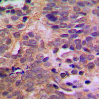 MDM2 Antibody - Immunohistochemical analysis of MDM2 (pS166) staining in human breast cancer formalin fixed paraffin embedded tissue section. The section was pre-treated using heat mediated antigen retrieval with sodium citrate buffer (pH 6.0). The section was then incubated with the antibody at room temperature and detected using an HRP conjugated compact polymer system. DAB was used as the chromogen. The section was then counterstained with hematoxylin and mounted with DPX.