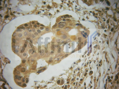 MDM2 Antibody - 1/100 staining human breast carcinoma tissue by IHC-P. The sample was formaldehyde fixed and a heat mediated antigen retrieval step in citrate buffer was performed. The sample was then blocked and incubated with the antibody for 1.5 hours at 22°C. An HRP conjugated goat anti-rabbit antibody was used as the secondary antibody.