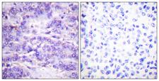 MDM2 Antibody - P-peptide - + Immunohistochemistry analysis of paraffin-embedded human breast carcinoma tissue using MDM2 (Phospho-Ser166) antibody.