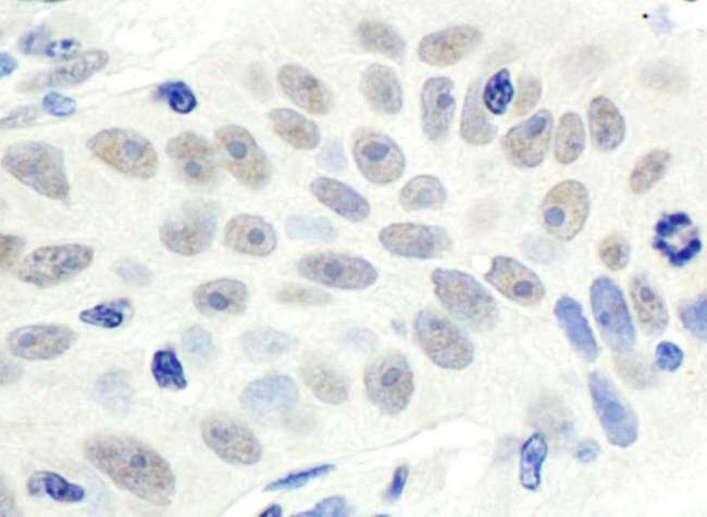 MDM4 / MDMX Antibody - Detection of Human HdmX/MDM4 by Immunohistochemistry. Sample: FFPE section of human lung carcinoma. Antibody: Affinity purified rabbit anti-HdmX/MDM4 used at a dilution of 1:1000 (1 ug/ml). Detection: DAB.