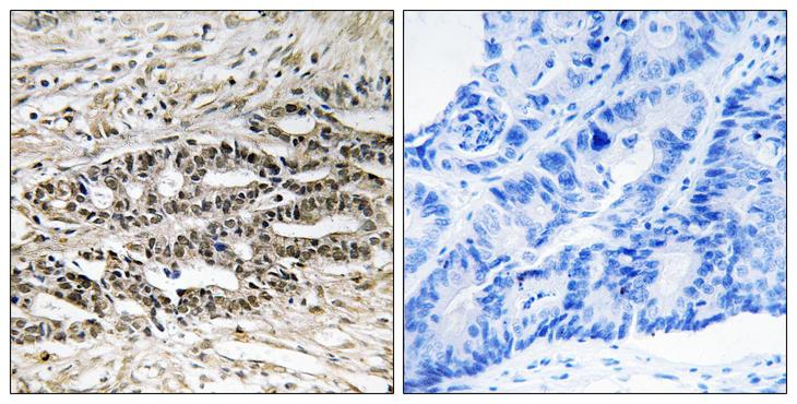 MDM4 / MDMX Antibody - Immunohistochemistry analysis of paraffin-embedded human colon carcinoma tissue, using MDM4 Antibody. The picture on the right is blocked with the synthesized peptide.