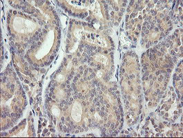 MDM4 / MDMX Antibody - IHC of paraffin-embedded Carcinoma of Human thyroid tissue using anti-MDM4 mouse monoclonal antibody.