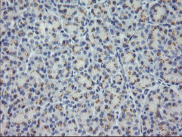 MDM4 / MDMX Antibody - IHC of paraffin-embedded Carcinoma of Human lung tissue using anti-MDM4 mouse monoclonal antibody.