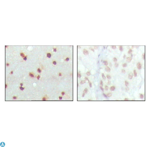 MDM4 / MDMX Antibody - Immunohistochemistry (IHC) analysis of paraffin-embedded human cerebra (left) and lung carcinoma (right) tissues, showing nuclear localization with DAB staining using MDMX Monoclonal Antibody.