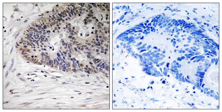 MDM4 / MDMX Antibody - Immunohistochemistry analysis of paraffin-embedded human colon carcinoma, using MDM4 (Phospho-Ser367) Antibody. The picture on the right is blocked with the phospho peptide.