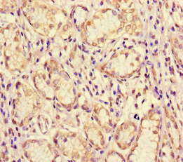 ME1 / Malate Dehydrogenase Antibody - Immunohistochemistry of paraffin-embedded human gastric cancer at dilution of 1:100